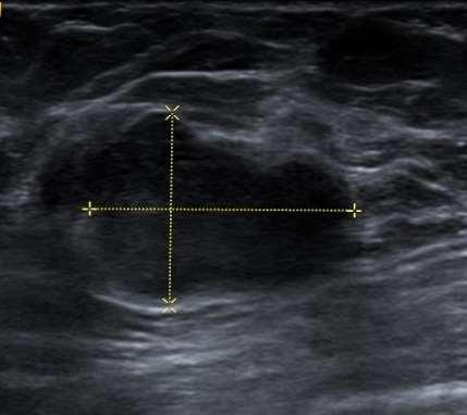 Phylloides tumor szolid lehet malignus!