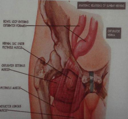 Hernia inguinalis