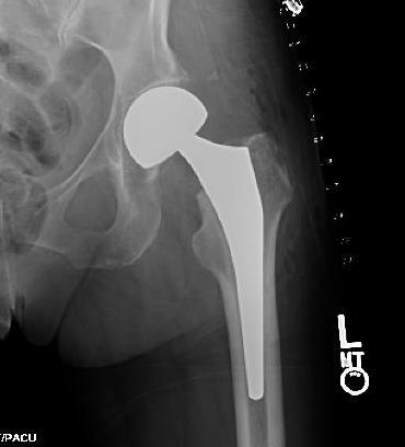 Arthroplastica Hemiarthroplastica cervicocapitalis protézis Idősebb