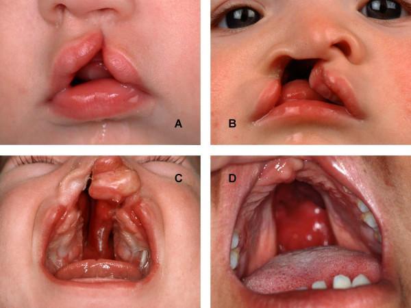 frissített RSV munkacsoport palivizumab a high risk