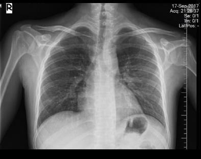 Erçelik M et al. Bronchial lavage was taken with bronchoscopy on patient who could not give sputum. Pneumocystis jirovecii was detected in lavage culture.