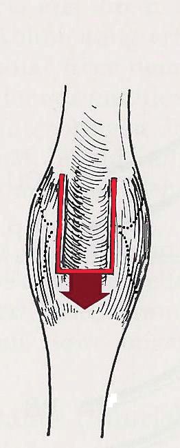 módszere szerint a) tenyéri bőrmetszés b) distal felé