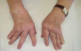 Arthritis (synovitis) 3 areában (>6 hete) 3.