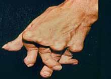 Szimmetrikus arthritis (>6 hete) 5. Rheumatoid csomók 6.