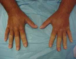 Polyarthritis-polyarthralgia Myositis