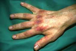 Idiopathiás inflammatoricus myopathiák (IIM) o A proximális végtagizmok