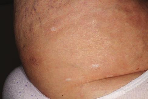 A mlignus trophiás ppulosis súlyos formáin firinolitikus vgy immunszuppressziv (cyclosporine A, zthioprine, cyclophosphmide, corticosteroid) terápiákkl rendre kudrcot vllnk.