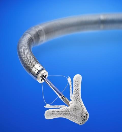 MitraClip By approximating the anterior and posterior mitral leaflets and forming a double-orifice valve, the MitraClip device reduces MR Registries have suggested that the MitraClip is safe and may