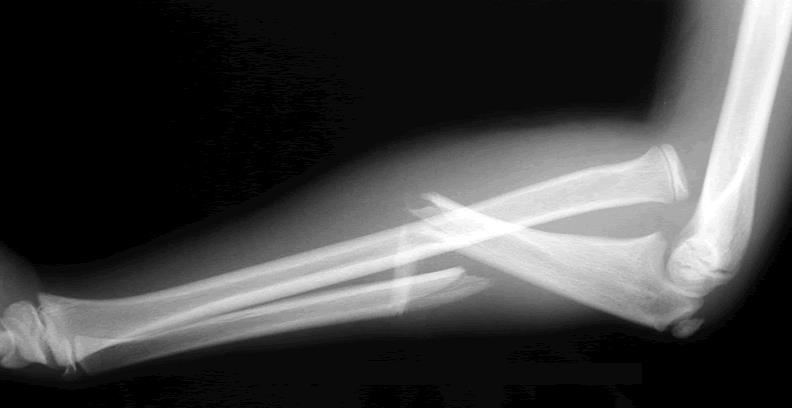 Monteggia sérülés Ulna proximalis ill.