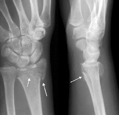 humerus proximalis végének törése gyógytorna)