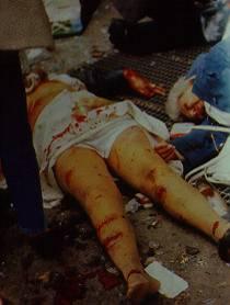 A polytrauma fogalma Sérültek, akik különböző testtájékon, ill.