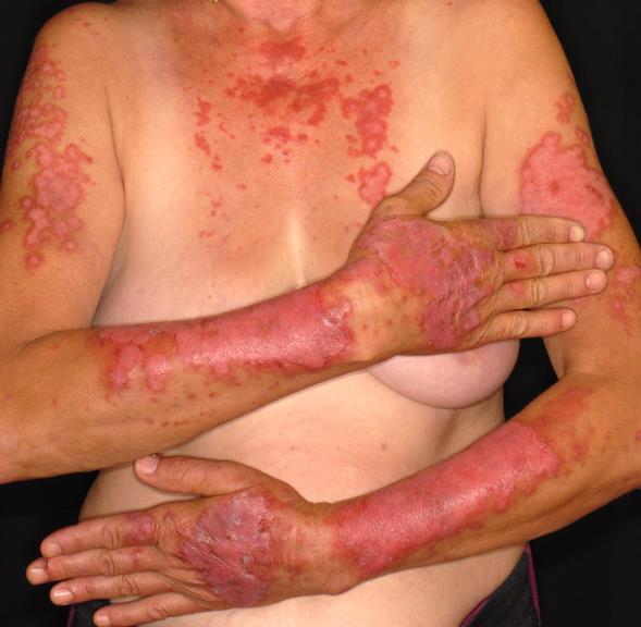Pemphigus csoport Pemphigoid