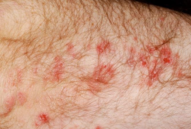 Lupus erythematosus csoport
