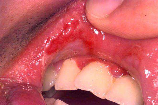 Pemphigus csoport intraepidermalis hólyag ( hámban) gyulladásmentes alap, petyhüdt