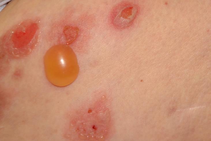 Pemphigoid csoport