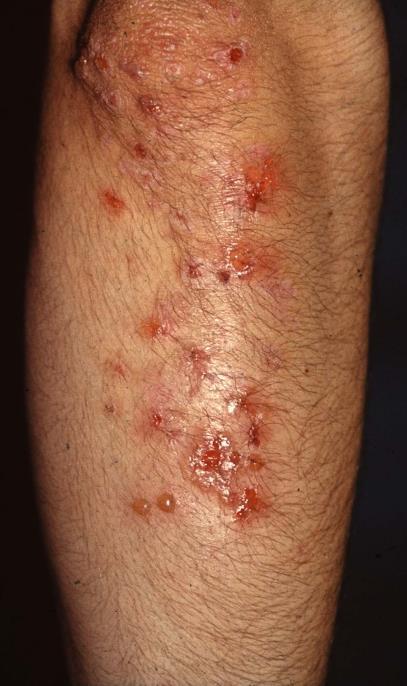 Dermatitis herpetiformis /DH/