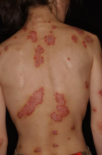 Lupus erythematosus