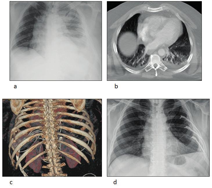 3 ábra a 37 éves férfi AP mellkas felvételén 3 borda több mint 15 mm-es összecsúszása látható b enyhe (<18%) kiterjedésű tüdő kontúzió c 3D CT alapján jól megtervezhető, mely bordákat szükséges