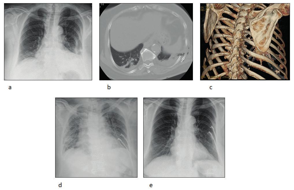 ábra a 71 éves nőbeteg AP mellkas röntgenképe b A CT felvételen látható a teljes csontszélességű elmozdulással járó bordatörés és haemothorax c 3D CT demonstrálja a mellkas térfogatát jelentősen