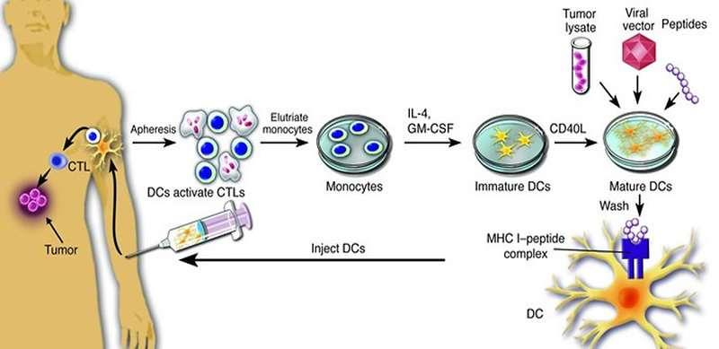Tumor ellenes vakcina DC-vel 1. A beteg monocitából in vitro differenciáltatott DC + tumor-antigének 2.
