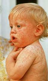 MMR: Kanyaró -morbilli kanyaró vírus igen fertőző (99-100%)- megtalálja a fogékonyakat 14 nap lappangási idő 4 napos, hurutos bevezető szakasz jellegzetes, foltos kiütések arcon is, testen is