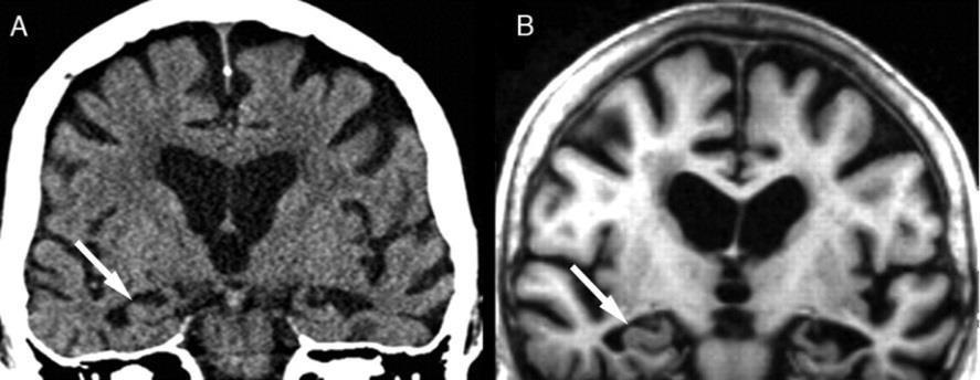 Hippocampus atrophia (amci): A célingerhez kapcsolódó kép felismerésének zavara, célinger