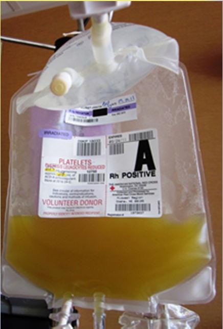 Trombocita transzfúzió gyakorisága Pandey S. et al: Transfusion S 52. 65S-79S. 2012. Mc Cullough J: Transfusion Medicine 3th edition 238-304. 2012.: Többször kevesebbet (beavatkozás előtt 1-2 órával) Vérzéskockázat, gyakoriság nem különbözik: thr szám 5.