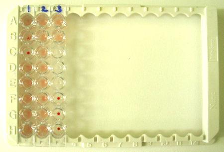 (malária is), sepsis, splenomegalia, gysz (acetil-szalicilsav) antibiotikum (amfotericin B, vancomycin, ciprofloxacin, sumetrolim, Bactrim) masszív vérzés, DIC, AI bet: SLE, ITP heparin hatás Imm-i: