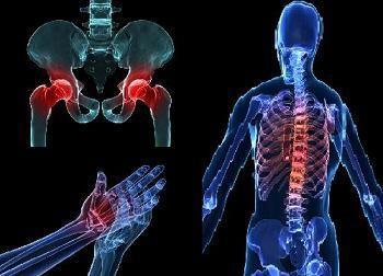 Osteoporotikus törés Életkor Nem Alacsony csont ásványi anyag tartalom (BMD) Romló csont minőség (quality of bone) Mikroarchitektura károsodása