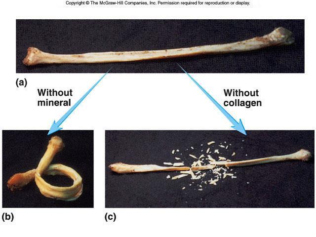 osteomalacia