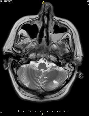 Középkorú férfi beteg Súlyos felső és alsó légúti tünetek Vese érintettség, dialízis Elhúzódó pulmonológiai kezelés Immunológiai konzílium PR3 ANCA pozitivitás Th: