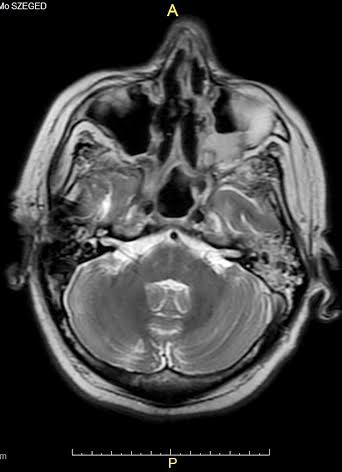 Itt kiterjedt csontdestructio jelei észlelhetők, mely a csontos és porcos septumra és a sinus maxillaris medialis falára is ráterjed. A sinus maxillarisban l.d. keskeny körkörös nyálkahártya megvastagodás látszik.