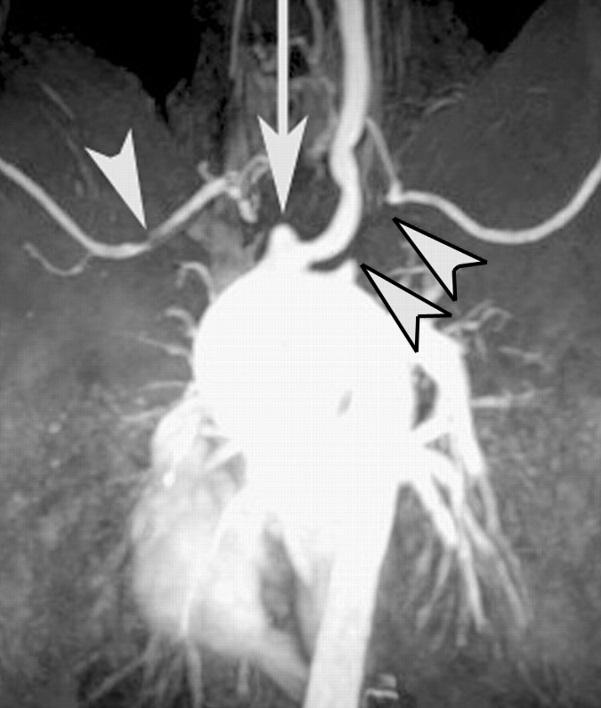 Nagyér vasculitisek Takayasu arteritis The American College of Rheumatology (ACR; 1990) 1.