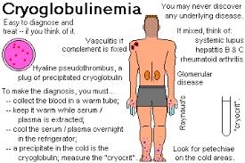 Cryoglobulinaemias vasculitis Vascuvaldic study: HCV eliminációja: 24 hét alatt 100% responder (87,5% CR, 12,5% PR) 46,1 %-ban cryoglobulin eltűnt Kell immunszuppresszio?