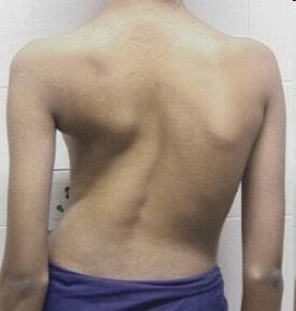 Scoliosis