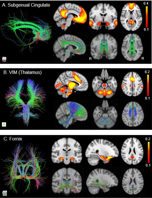 Mélyagyi stimuláció kezelése) vagy (Parkinson koponyán kór keresztüli stimuláció (depresszió