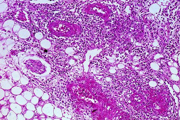 Periarteritis nodosa A