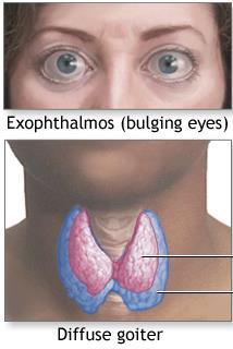 Grave-kór Jellegzetes klinikai tünet a kidülledt szem, a pajzsmirigy egyenletes megnagyobbodása, fogyás,