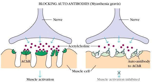 Myasthenia gravis Acetylcholin receptor elleni autoantitestek blokkolják a ideg-izom ingerület átvitelt.