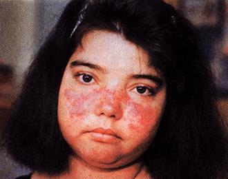 Jellegzetes pillangószárny" bőrpír egy fiatal SLE-s lány arcán Systemic Lupus Erythematosus (SLE) jellegzetességei a lázas állapotok, fogyás, ízületi gyulladás, bőrpír, mellhártyagyulladás,