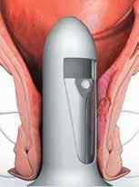 HAL - Haemorrhoidal Artery Ligation Mi a HAL lényege? Egy miniatur doppler ultrahang rz kelot vezetnek a v gb lbe.