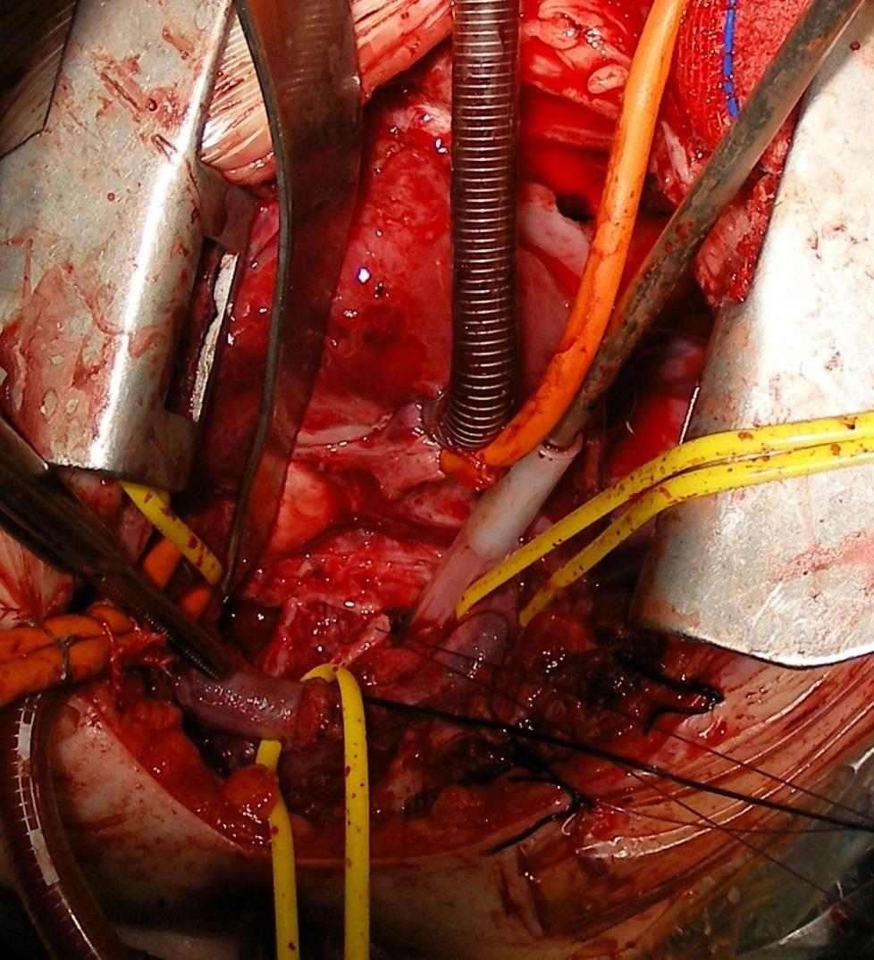 Laryngo-trachealis reconstructio Thoracotomia Kisvérköri keringést