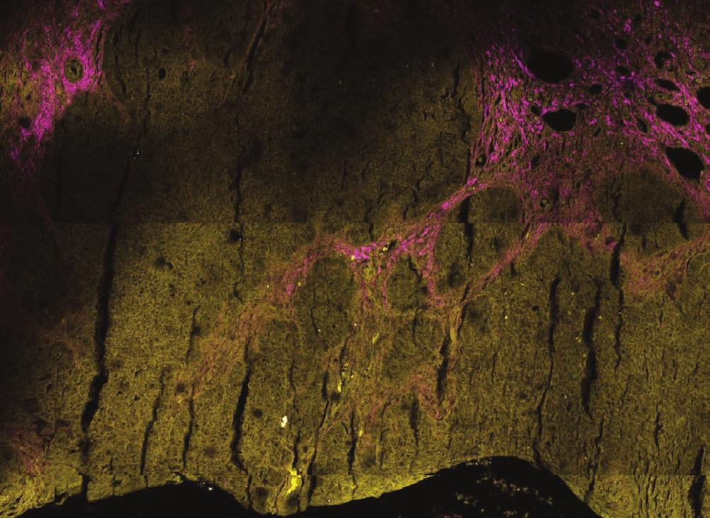 1. ábra Noduláris típusú basalioma kétfoton abszorpciós fluoreszcencia (two-photon absorption fluorescence, TPF, sárga színnel) és a másodharmonikus keltés (second harmonic generation, SHG, magenta