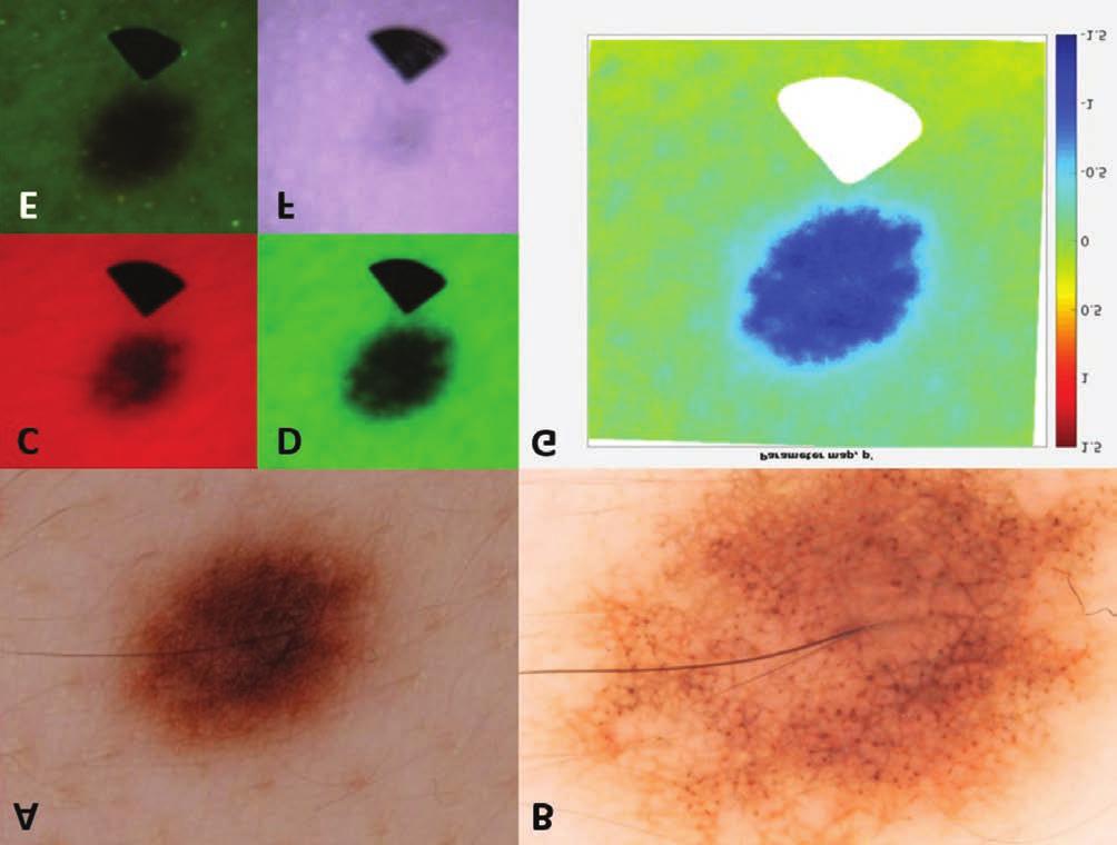 3. ábra Nevus pigmentosus RGB autofluoreszcencia (RGB-AF) vizsgálata.