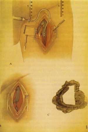 5 4. ábra. A./ A vénák lágyéki összeömlésének feltárása. Nyomásmérés a vénákban annak ellenırzésére, hogy a v. femoralis superflcialis és v.