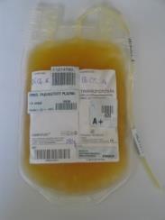 okt-től PAS-ban) Fvs-mentesítés: leukodepléció (vvs, thr) fvs: CMV, EBV-asszociáció NHLTR immunmoduláció