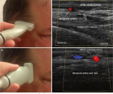 2. UH a. temporalis UH Indikáció: GCA giant cell arteritis gyanú esetén fejfájás, ceruzavastagságú a.