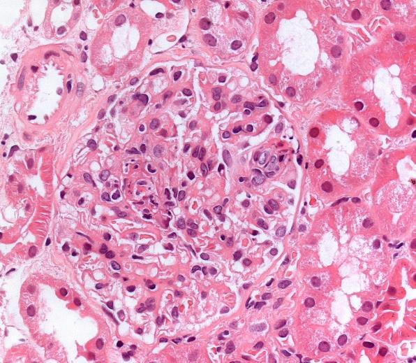 BIOPSIA 3. Izom A. Normál kép. B. Pathologias értágulat perifascicularis atrophias területen (nyíl) szövettörmelék accumulatioval C. Segmentalis ér occlusio (nyíl). D.