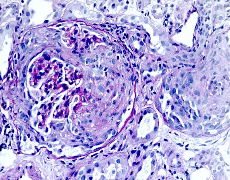 BIOPSIA 4. Vese Félholdképződéssel járó GN Prof. Dr.