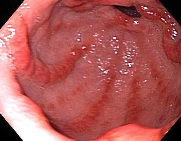 ENDOSCOPIA GERD - oesophagus GAVE Gastric